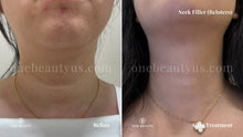 Load image into Gallery viewer, Belotero®: Neck Filler Treatment