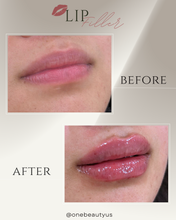 Load image into Gallery viewer, JUVÉDERM® : Lip Filler Augmentation