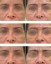 Load image into Gallery viewer, Platelet-rich plasma (PRP) Treatment