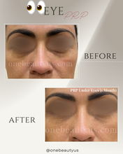 Load image into Gallery viewer, Platelet-rich plasma (PRP) Treatment