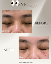 Load image into Gallery viewer, Platelet-rich plasma (PRP) Treatment