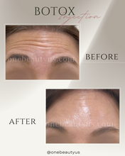Load image into Gallery viewer, BOTOX® Treatment