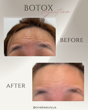 Load image into Gallery viewer, BOTOX® Treatment