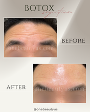 Load image into Gallery viewer, BOTOX® Treatment