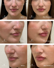 Load image into Gallery viewer, JUVÉDERM® : Lip Filler Augmentation