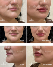 Load image into Gallery viewer, JUVÉDERM® : Lip Filler Augmentation