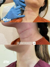 Load image into Gallery viewer, Belotero®: Neck Filler Treatment