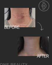 Load image into Gallery viewer, Belotero®: Neck Filler Treatment