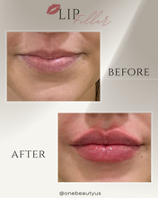 Load image into Gallery viewer, JUVÉDERM® : Lip Filler Augmentation
