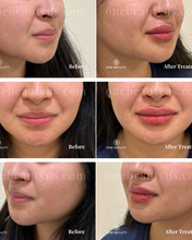 Load image into Gallery viewer, JUVÉDERM® : Lip Filler Augmentation
