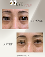 Load image into Gallery viewer, Platelet-rich plasma (PRP) Treatment
