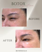 Load image into Gallery viewer, BOTOX® Treatment

