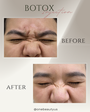 Load image into Gallery viewer, BOTOX® Treatment

