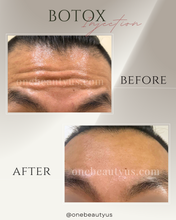 Load image into Gallery viewer, BOTOX® Treatment
