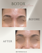 Load image into Gallery viewer, BOTOX® Treatment
