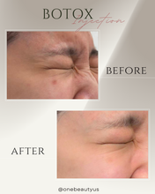 Load image into Gallery viewer, BOTOX® Treatment

