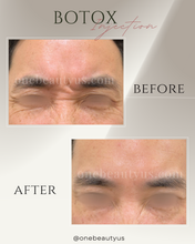 Load image into Gallery viewer, BOTOX® Treatment
