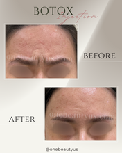 Load image into Gallery viewer, BOTOX® Treatment
