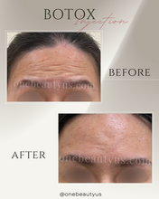 Load image into Gallery viewer, BOTOX® Treatment
