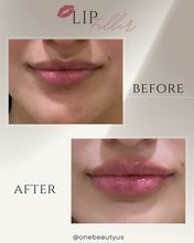 Load image into Gallery viewer, JUVÉDERM® : Lip Filler Augmentation
