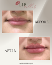 Load image into Gallery viewer, JUVÉDERM® : Lip Filler Augmentation
