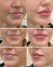 Load image into Gallery viewer, JUVÉDERM® : Lip Filler Augmentation
